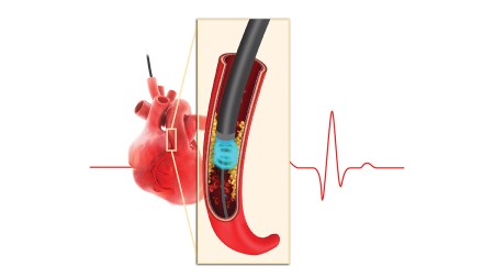 Excimer Coronary Laser Angioplasty becomes a ray of hope for patients with heart diseases