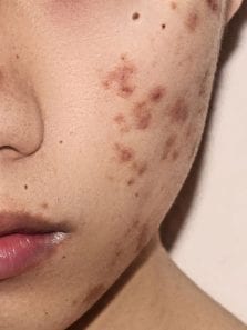 What is fungal acne