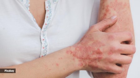 Psoriasis is a chronic autoimmune skin condition that can affect people of all ages, including children. (Source: Getty Images/ Thinkstock)