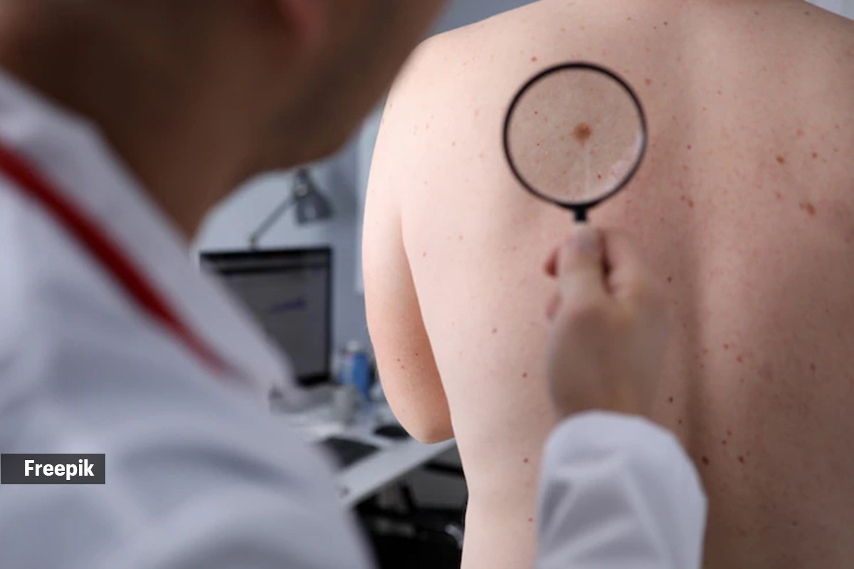 skin cancer 