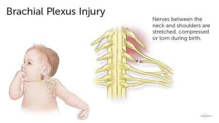 Brachial plexus birth injury: A comprehensive study