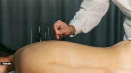 What is acupuncture?