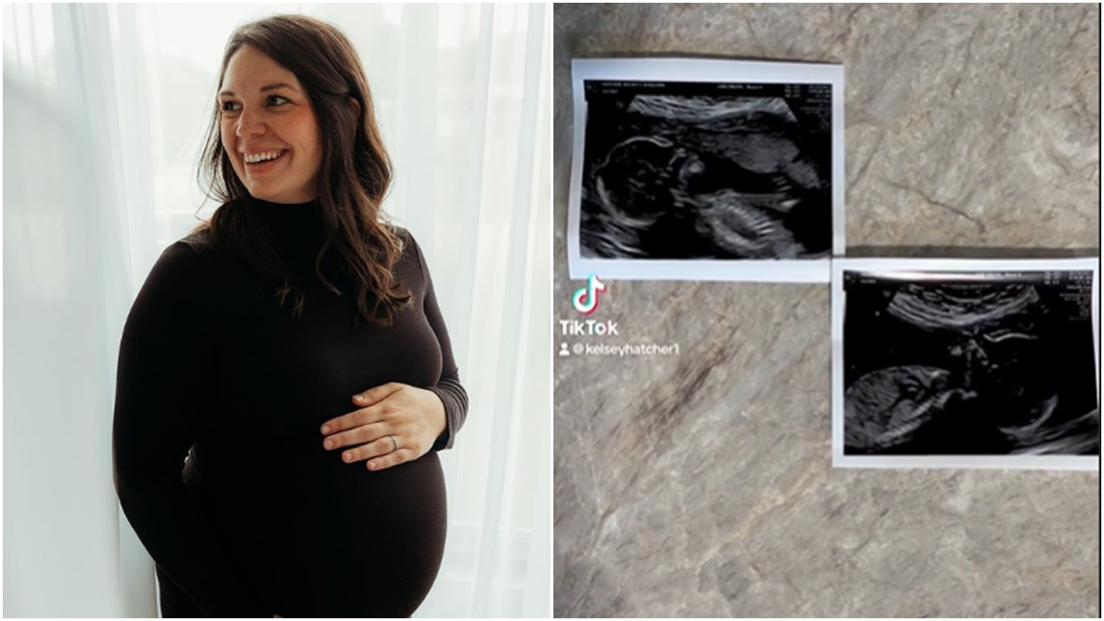 In a rare pregnancy, US woman with double uterus expecting babies in
