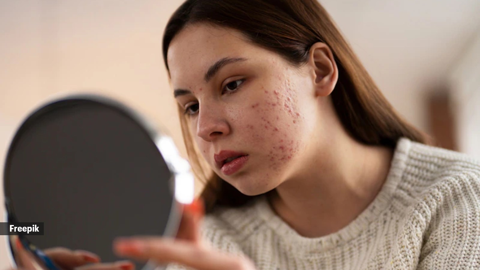 understanding-the-difference-between-acne-marks-and-scars-will-help-you