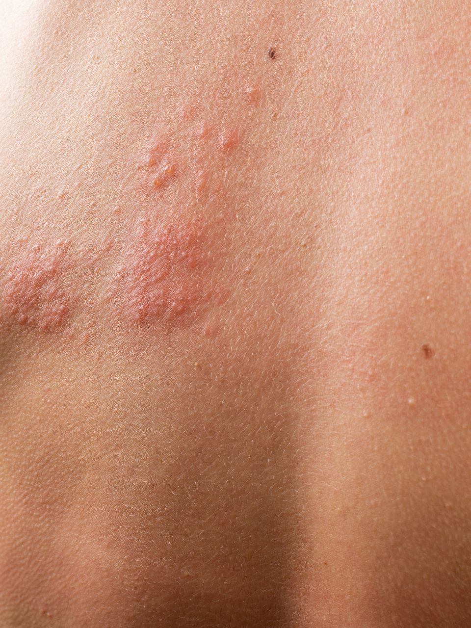 how-to-differentiate-between-rash-from-a-mosquito-bite-and-other-skin