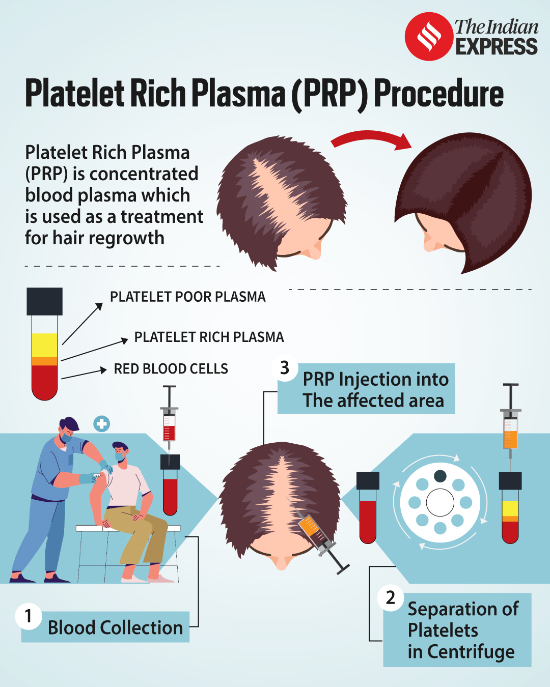 What is PRP therapy for hair loss?