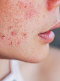 Manage inflammatory skin conditions by making these simple lifestyle changes