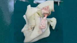 Cutting edge 3D skull model, temporomandibular joint replacement surgery, cancer survivors surgery, TMJ, skull dimensional model, cancer survivors, MRI, CT scans, indian express news
