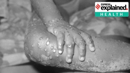 Why Congo's latest Mpox outbreak is concerning