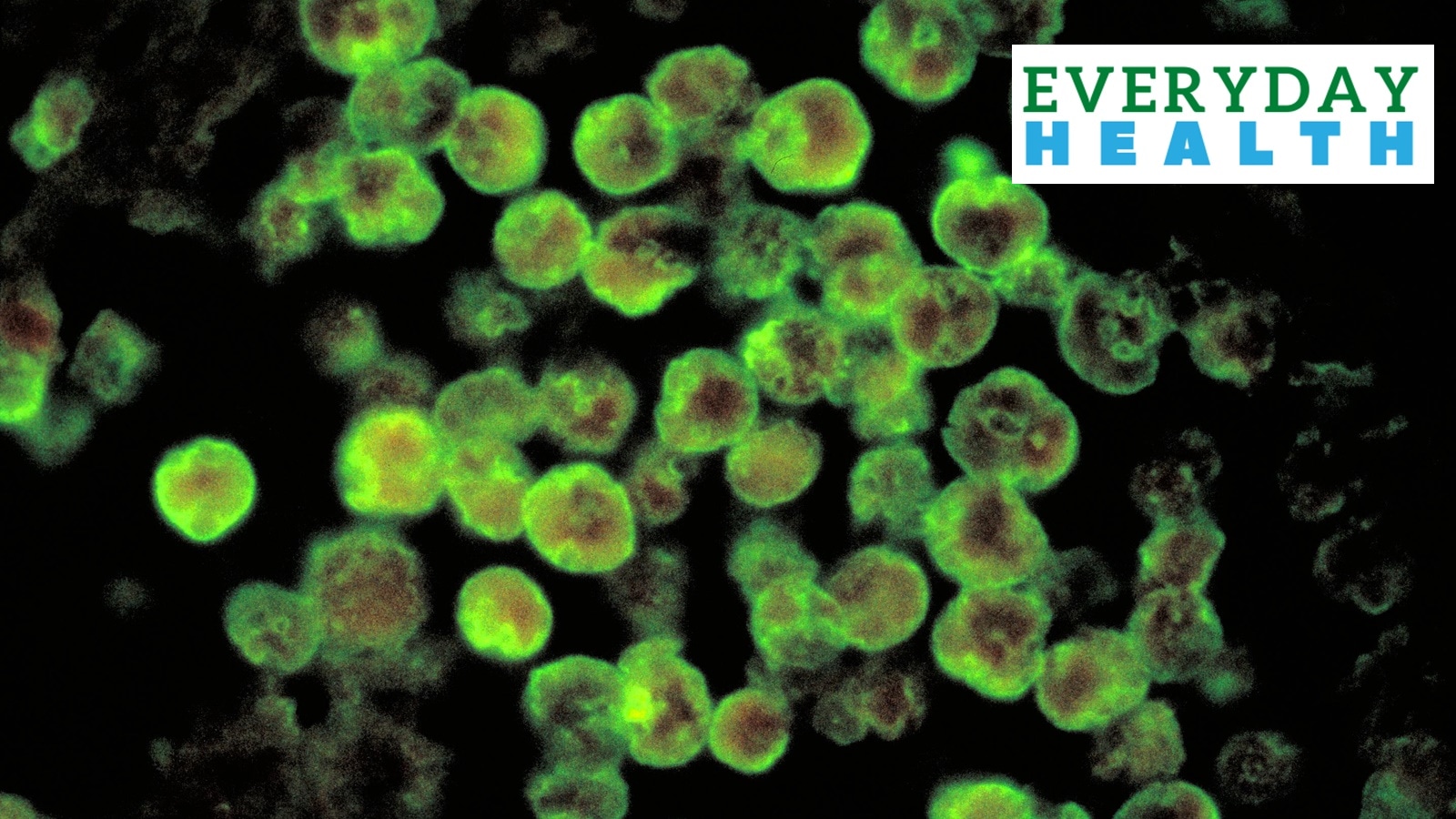 Histopathology of amebic meningoencephalitis due to Naegleria fowleri.