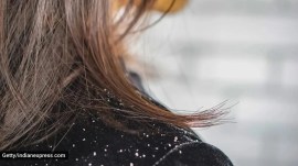 dandruff