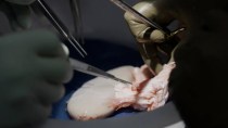 Xenotransplant: Are pig kidney transplants in humans sustainable?