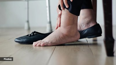 swollen feet