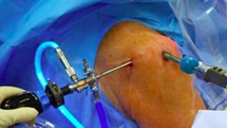 Overcoming Rotator Cuff Tears: Here’s what it is and why accurate diagnosis is imperative