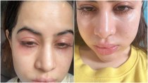 Uorfi Javed reveals reason behind her swollen face: ‘Fillers nahi hai guys…’