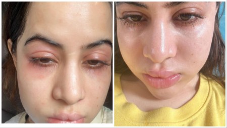 Uorfi Javed revealed the reason behind her swollen face.