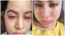 Uorfi Javed shares photos of swollen face, accepts she has been getting Botox since 18