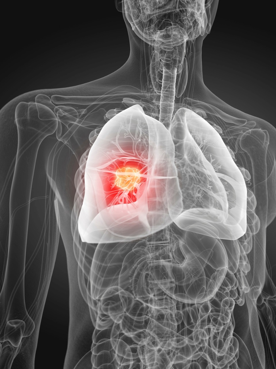 New findings reveal non-smokers at risk for lung cancer