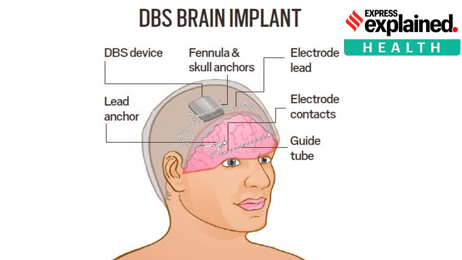 How the world’s first brain implant works to control epileptic seizures ...