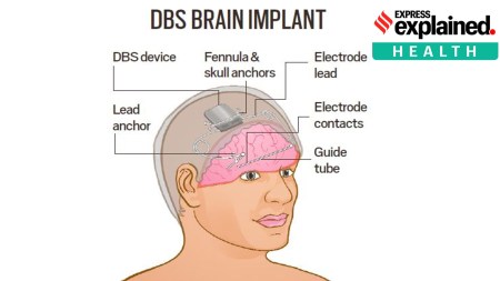 How the world’s first brain implant to control epileptic seizures works