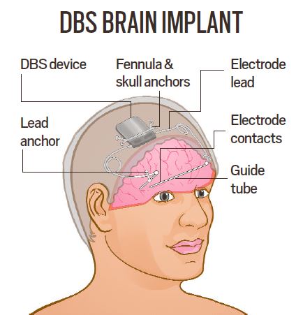 How the world’s first brain implant to control epileptic seizures works