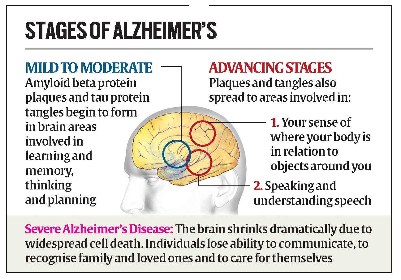 Stages of Alzheimer's