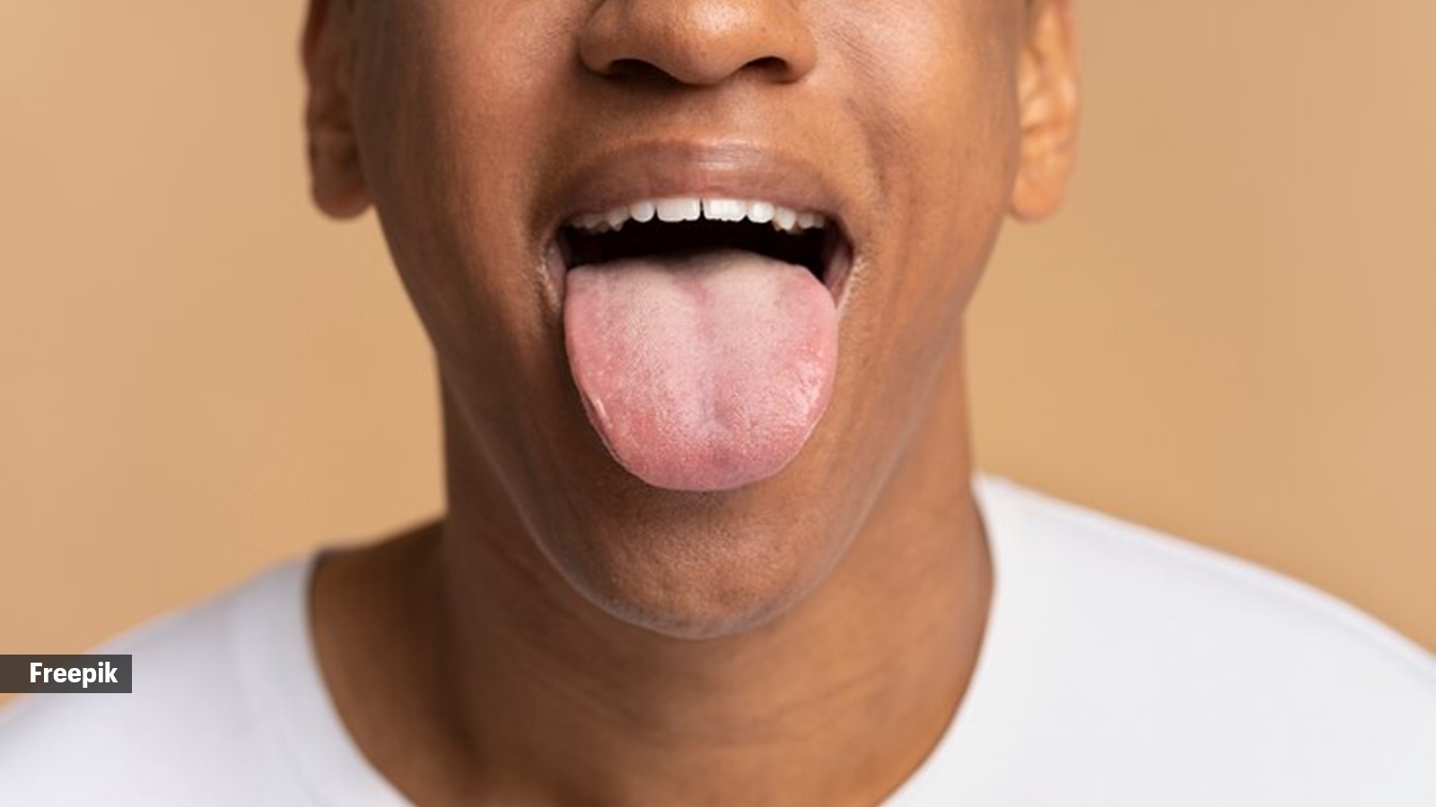 white tongue