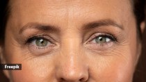 What does your eye discolouration say about your health?