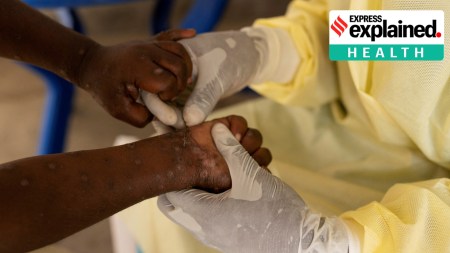 Why latest mpox outbreak is ‘emergency of international concern’