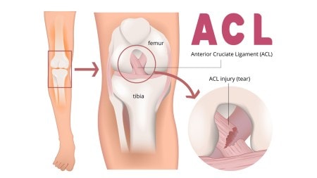 From Injury to Recovery, Here is How to Treat ACL Tears with Personalized Care