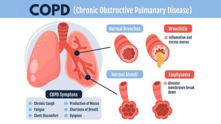 Chronic Pulmonary Diseases