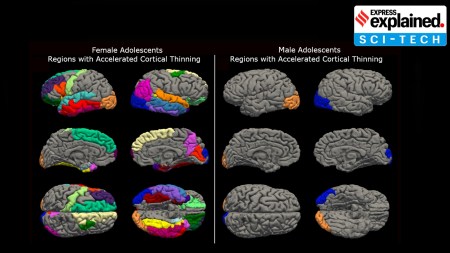 Teen girls’ brains aged rapidly during pandemic, study finds