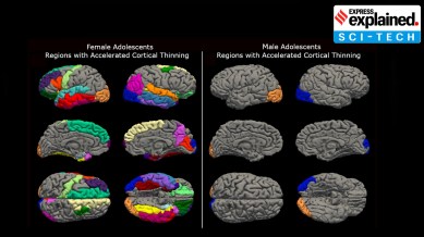 Teen girls’ brains aged rapidly during pandemic, study finds