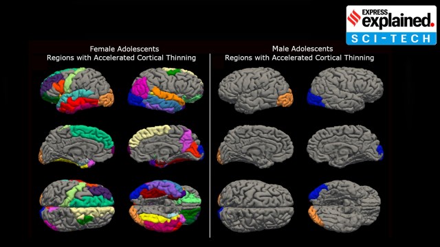 Teen girls’ brains aged rapidly during pandemic, study finds