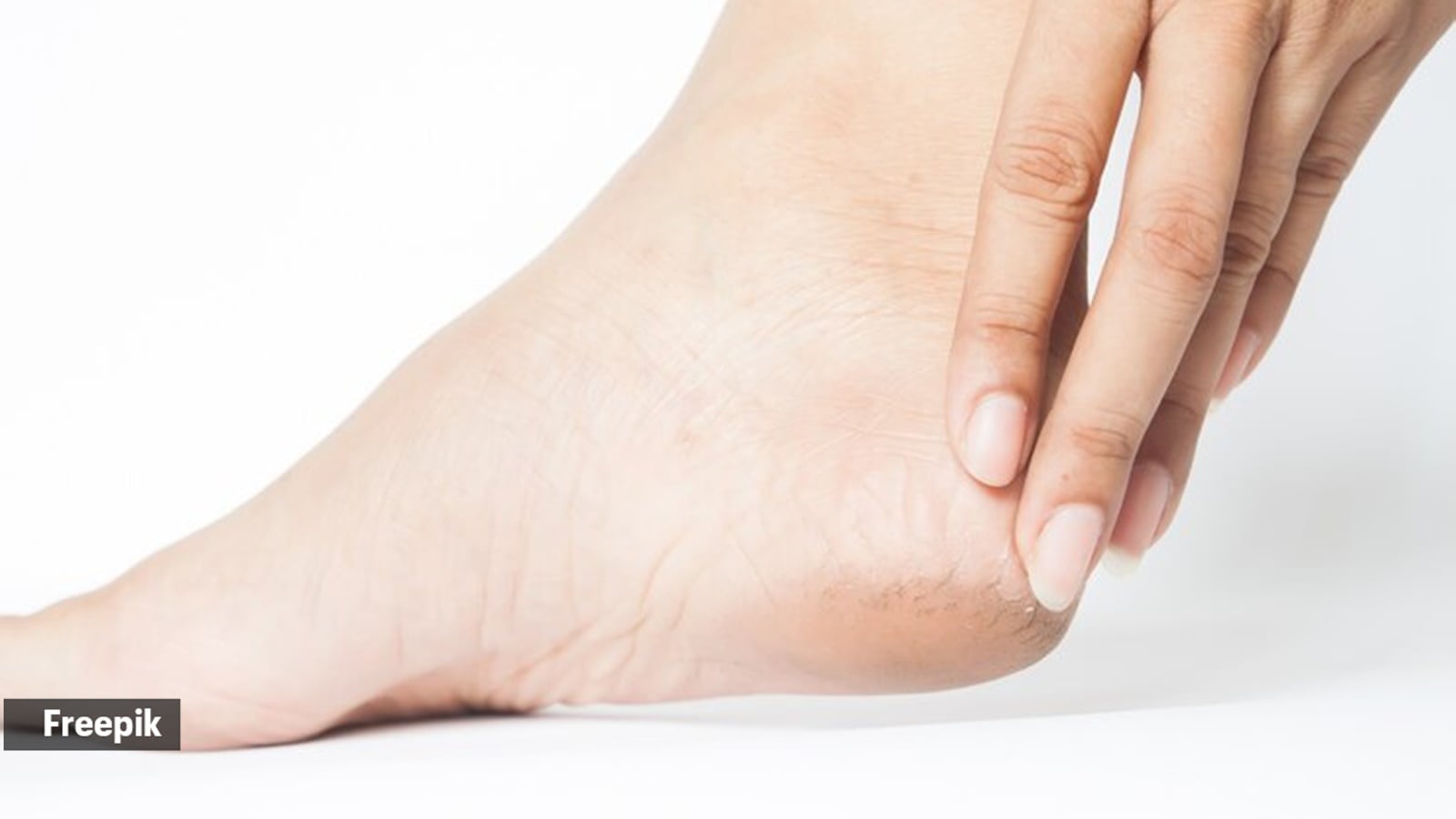 cracked feet