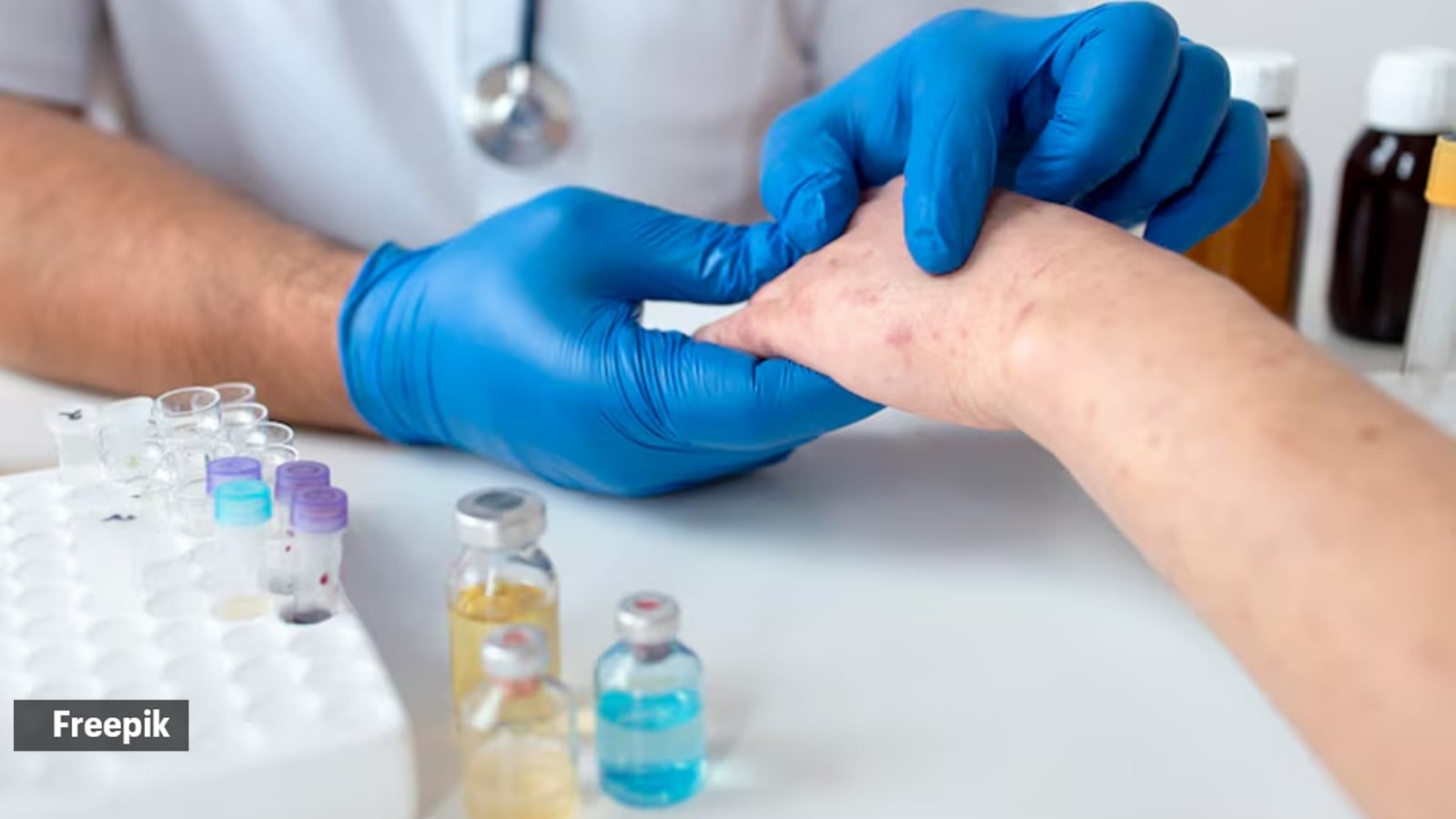 Mpox clade 1 variant detected in Kerala: Should you be worried?