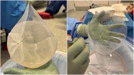 Titanium-coated mesh transforms breast reconstruction for cancer patients