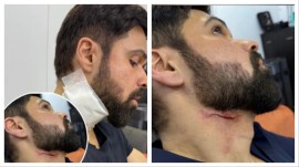 Emraan Hashmi got injured while shooting Goodachari 2