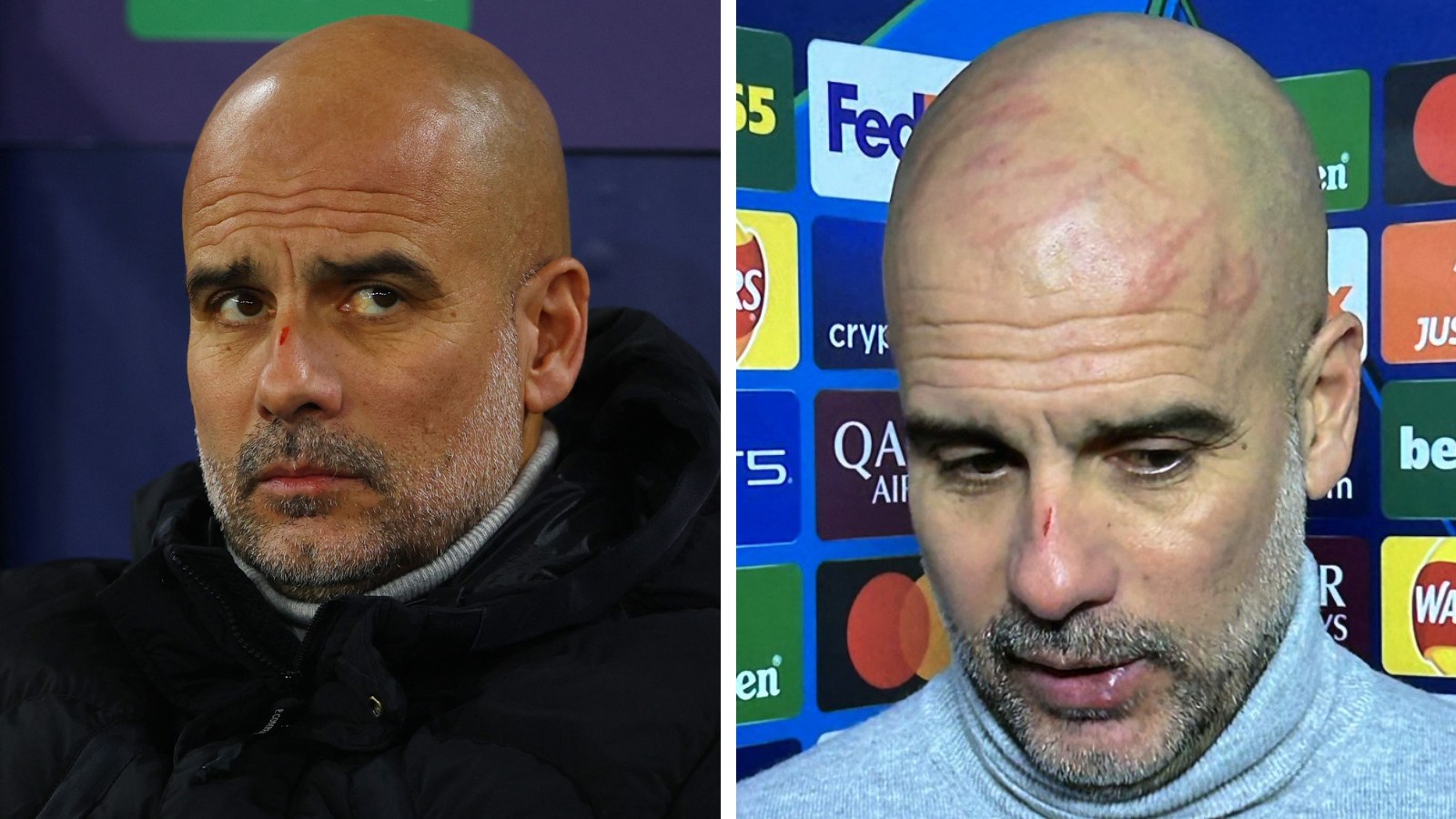 Guardiola Scratch ‘I want to harm myself’: Pep Guardiola reveals reason for scratches on ...