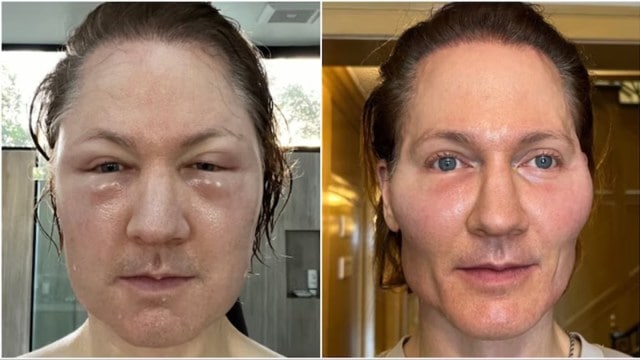 Johnson shared images of his swollen look   connected  Instagram, detailing the ordeal.