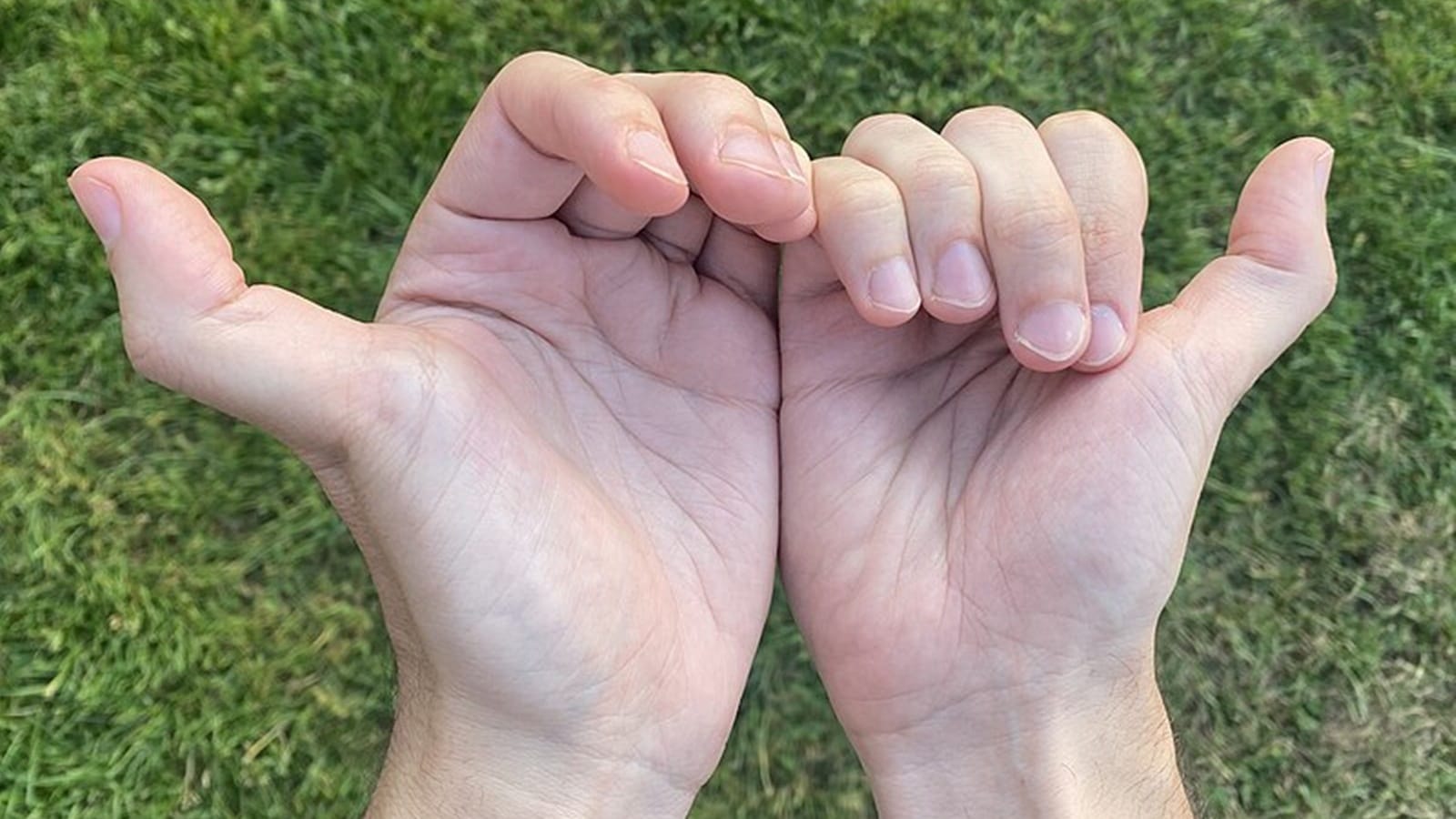 Why ‘double-jointed’ isn’t always a health win