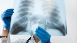 What are the four types of pneumonia?