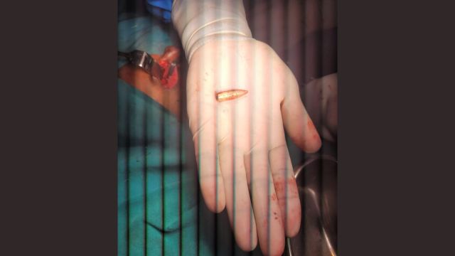 'Foreign object' stuck inside girl's neck was a bullet, safely removed