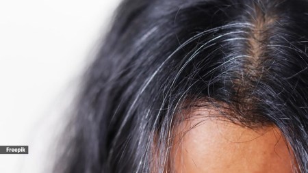 Grey hair results from the depletion of melanocytes, the cells responsible for producing melanin