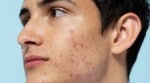 Discover why popping pimples can worsen acne and lead to complications