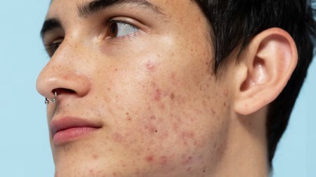 Discover why popping pimples can worsen acne and lead to complications