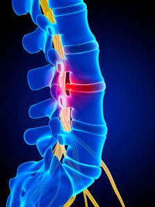 Benefits of a balanced approach to weight loss for slip disc recovery