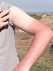 Sunburn treatment: Dermatologist backed tips to heal faster