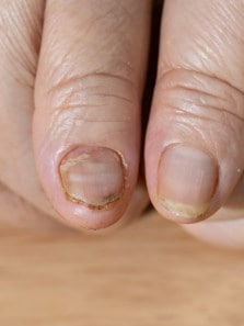 What happens to your nails during chemotherapy?