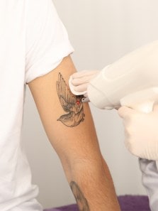 What to expect during tattoo removal: 6 key points